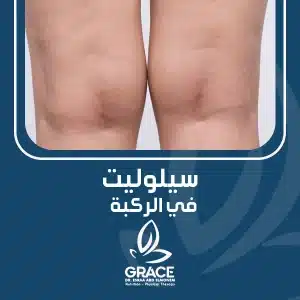 سيلوليت في الركبة
