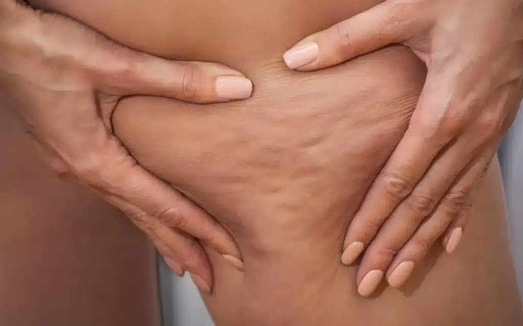 هل يمكن التخلص نهائيًا من سيلوليت الركبة