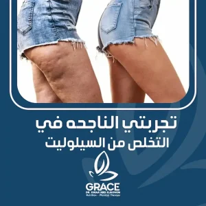 تجربتي الناجحه في التخلص من السيلوليت