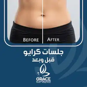 جلسات كرايو قبل وبعد